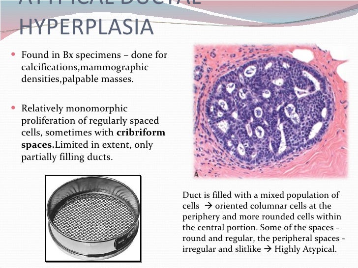 Breast atypical hyperplasia Breast atypical hyperplasia